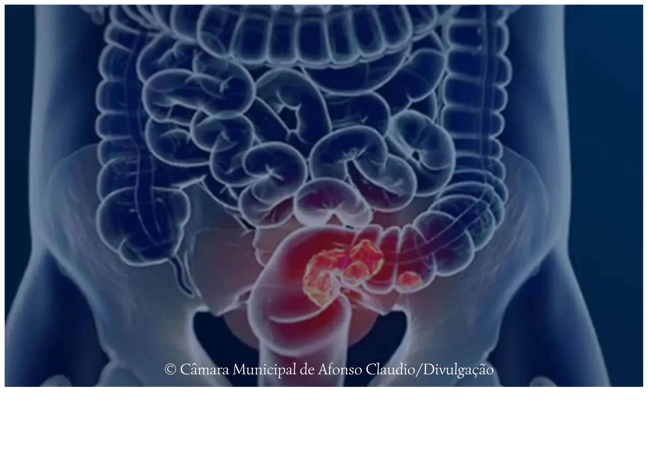 Alerta no Dia Nacional: Mais de 60% dos Casos de Câncer Colorretal São Diagnosticados em Estágio Avançado